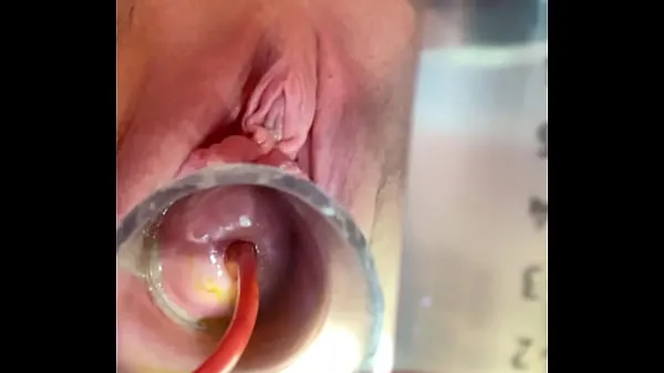 XXX Cries from as catheter balloon expands top Videos